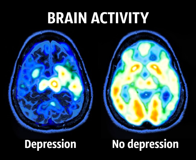 Depression In The Brain IN LIGHT MENT